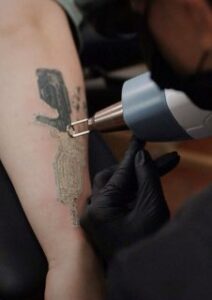 Удаление татуировок