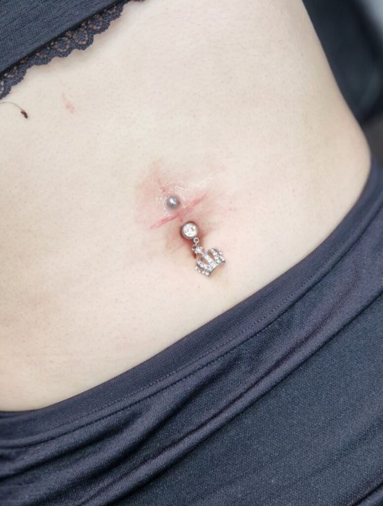 Удаление татуировок - Imaginea 1