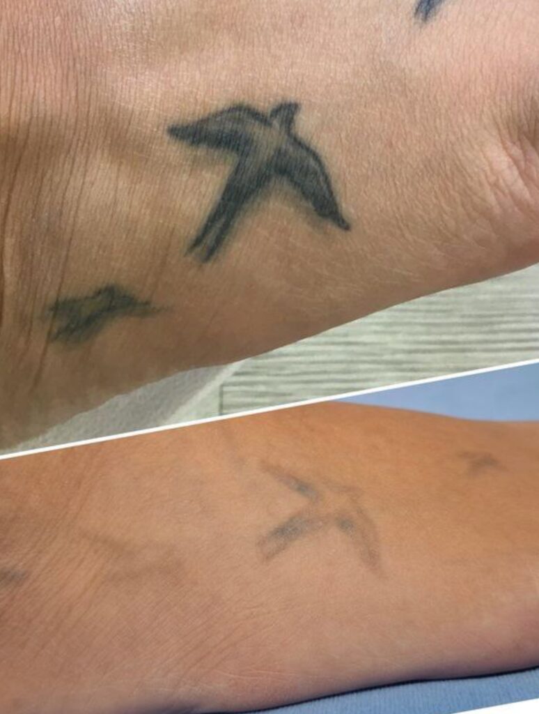 Удаление татуировок - Imaginea 2