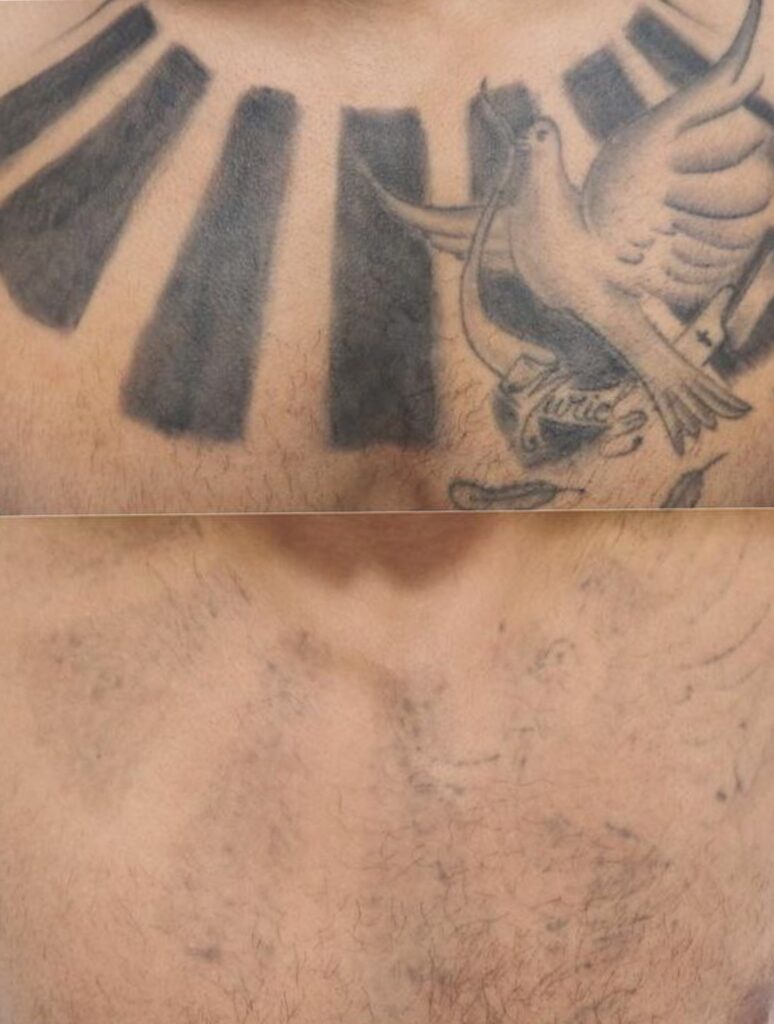 Удаление татуировок - Imaginea 3