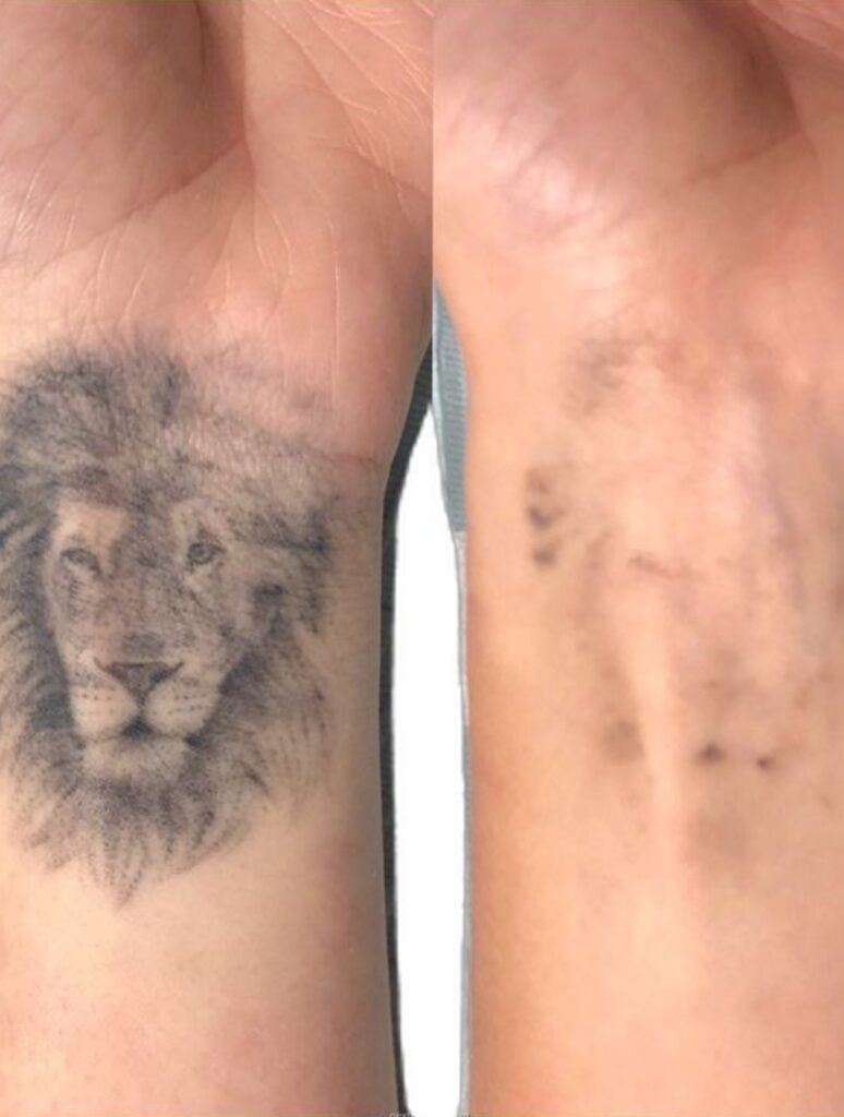 Удаление татуировок - Imaginea 4