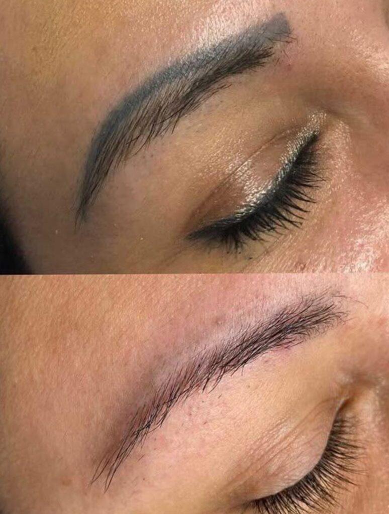 Удаление татуировок - Imaginea 5