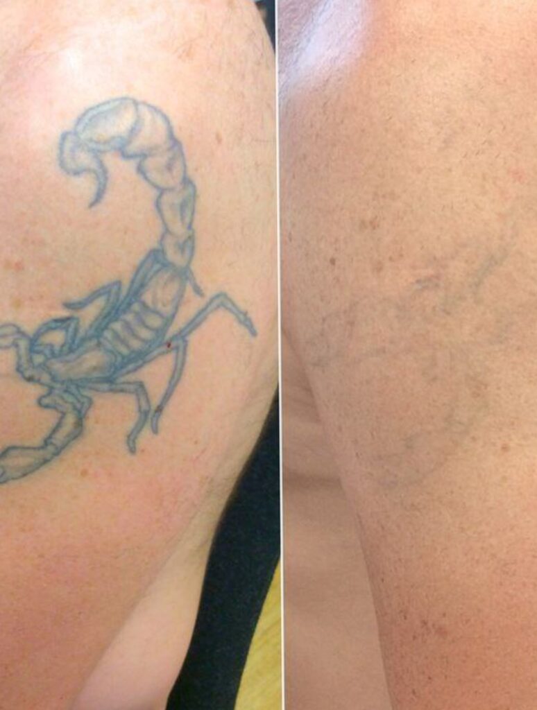 Удаление татуировок - Imaginea 6