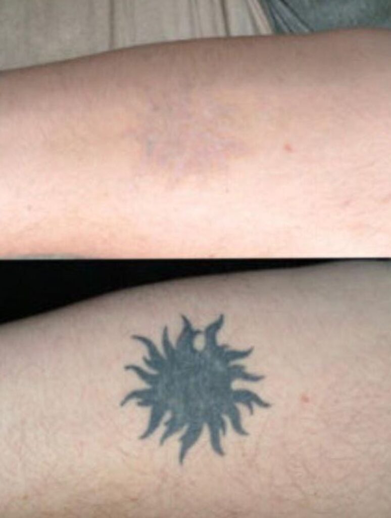 Удаление татуировок - Imaginea 7